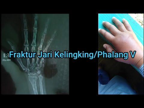 Video: Cara Membedakan Jari Kelingking Yang Memar Dari Patah Tulang: Saran Dokter