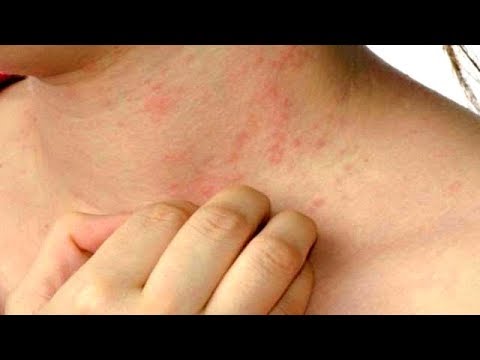 كيف تعرف أن جسمك مليء بالبكتيريا و الجراثيم الضارة