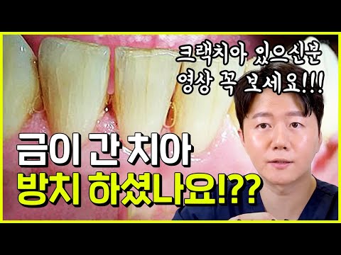 금이 간 치아 있으신분!!! 크랙치아 방치하면 발치 할수도!?