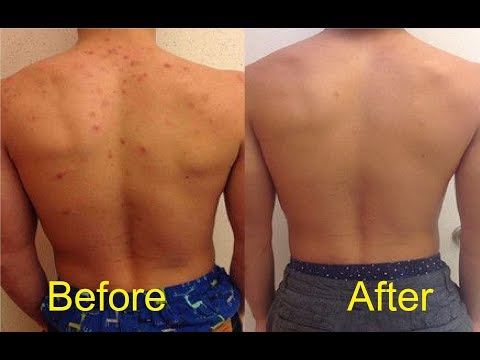 how to get rid of acne on chest and back