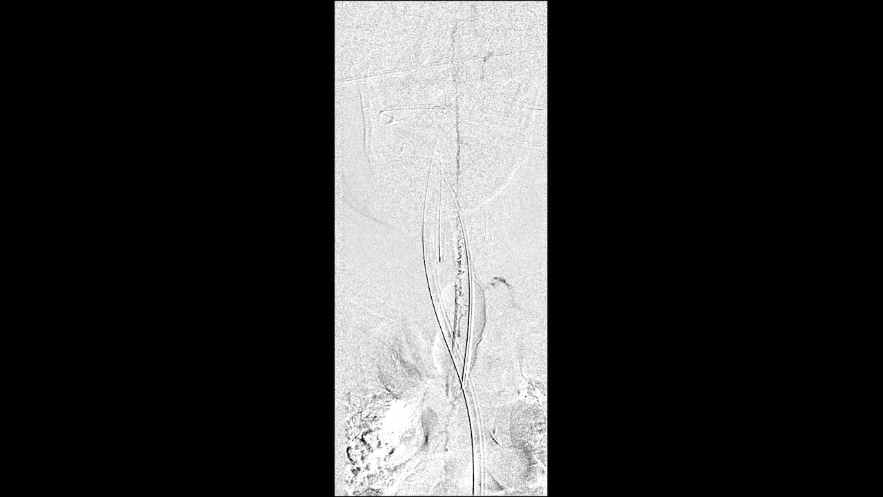 SDAVF Case 1 Pre-embo fistula delayed runoff.avi