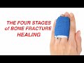 Stages of Fracture Healing and Their Biological Significance