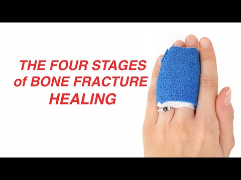 The Four Stages of Bone Fracture Healing