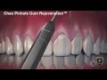 Chao Pinhole Surgical Technique Dr. Noroozi IMPrESS Perio Vancouver Periodontist