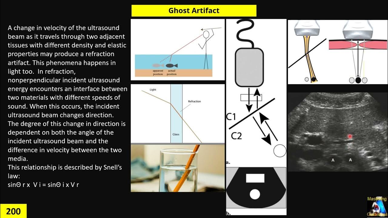 Artifacts in ultrasound 4 refraction artifact youtube