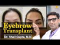 Eyebrow Transplant in Delhi | Eyebrow Hair Transplant India, Amazing results by Dr Shail Gupta