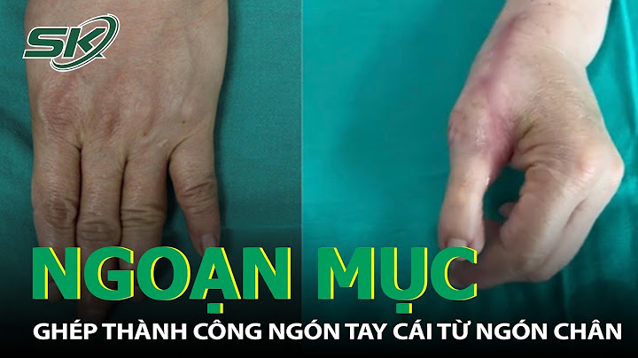 Nối ngón tay hết bao nhiêu tiền