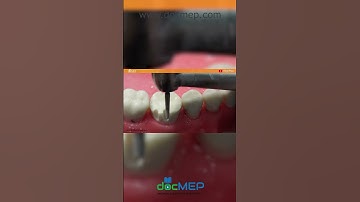Tooth Preparation for All-ceramic Posterior Crown