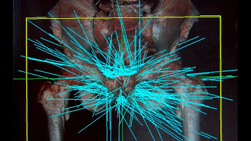 CyberKnife for Prostate Cancer