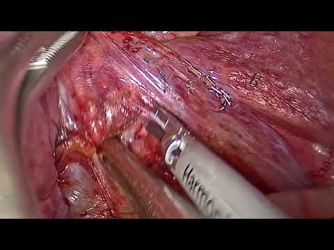 Single port VATS lingular segmentectomy