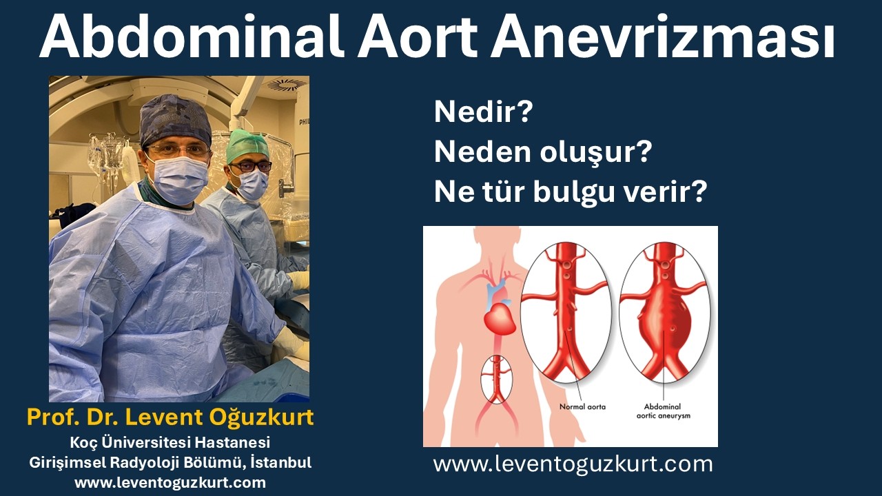 Abdominal aort anevrizması nedir bilgilendirme videosu - Prof. Dr. Levent Oğuzkurt