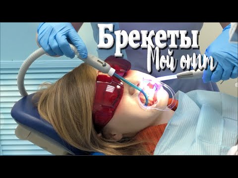 СТАВЛЮ БРЕКЕТЫ / ПЕРВЫЕ ОЩУЩЕНИЯ СТАВЛЮ БРЕКЕТЫ / ПЕРВЫЕ ОЩУЩЕНИЯ