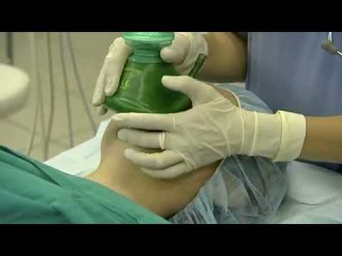 Videó: Milliméteres Műtét. Orvos Az Orrplasztikáról