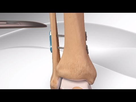 High Ankle Sprain Rehabilitation — Michael Braccio