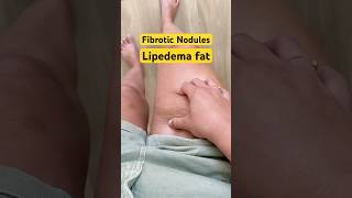 My Lipedema Reality Adipose Cuffs, Nodules & Invisible Pain