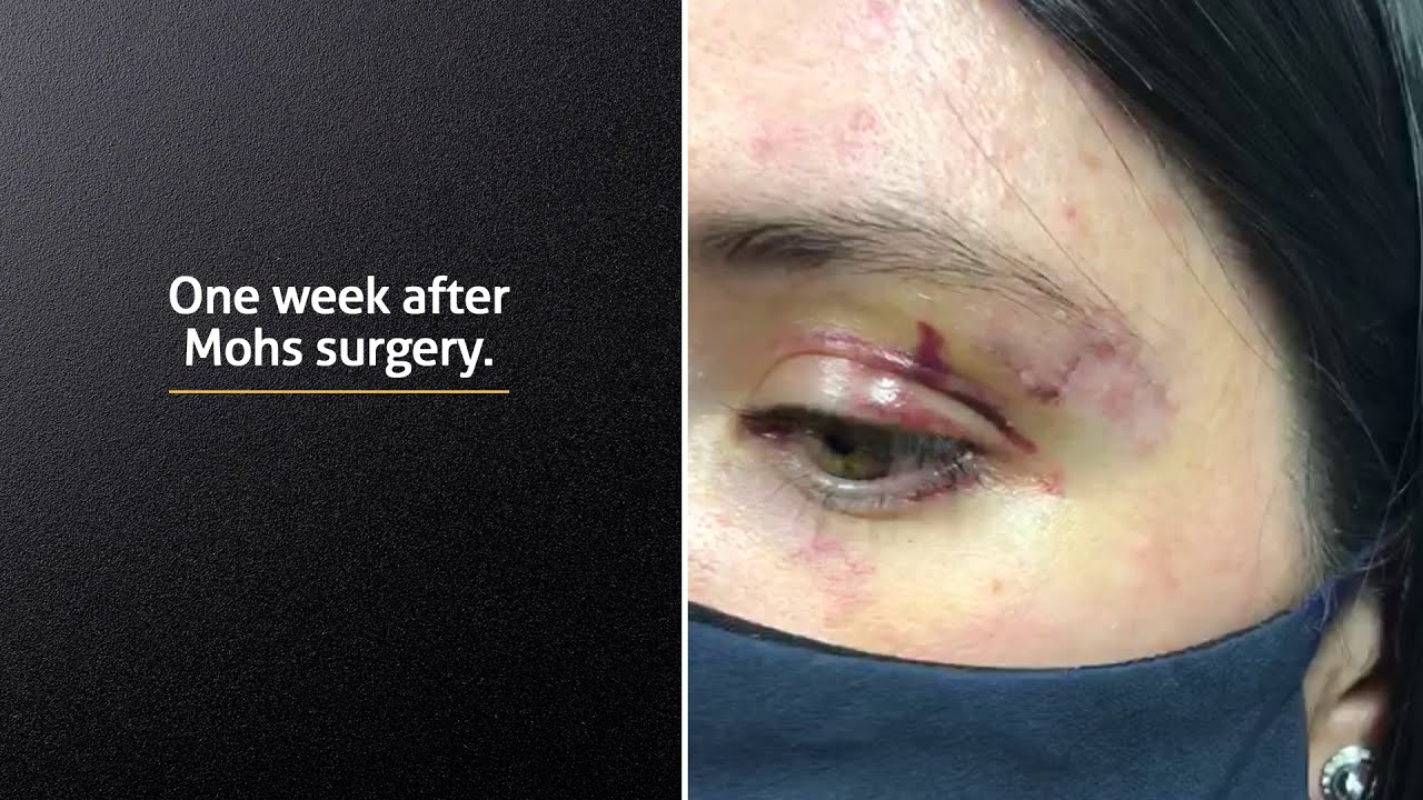 Mohs surgery for the treatment of eyelid cancer