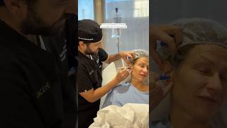 Deep Plane Face and Neck Lift combined with an Upper Lip Lift ✨
