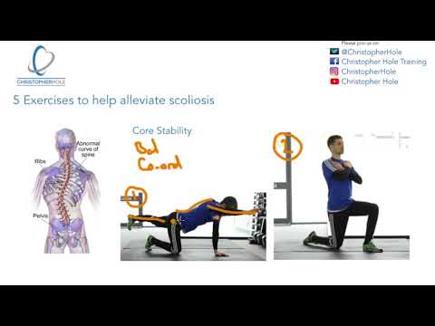 5 exercises that help alleviate scoliosis