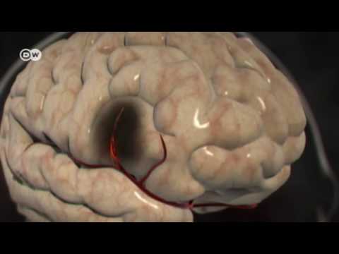 Video: ¿Durante un accidente cerebrovascular isquémico?
