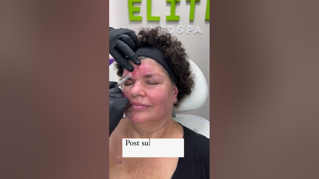 Post surgical scar treatments dr natalia hegedosh cosmetic