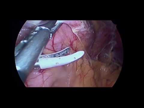 Video: Vertikal Ermet Gastrektomi: Kirurgi For Vekt