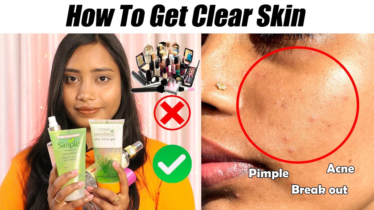 HOW I CLEARED MY SKIN IN A WEEK | How to clear ACNE PIMPLE & BREAKOUTS ...