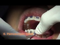 Penasaran Kalau Pasang Behel Apa Saja Tahapannya? Cek Proses Pasang Behel Oleh Dokter Gigi Kami