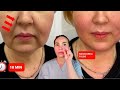 Effective techniques for the nasolabial folds  no words