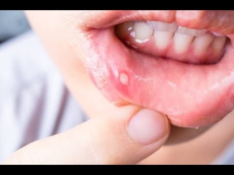 Owrzodzenia jamy ustnej – 7 sposobów leczenia |Zdrowie 24h