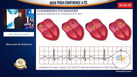 Top Ten Neonatal Arrythmias Prof Ahmed Ismaiel