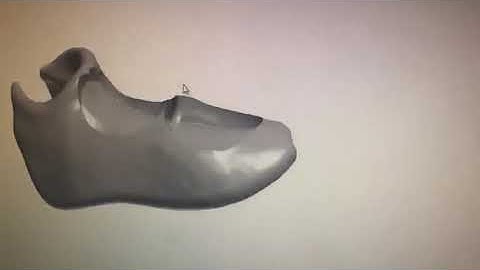 CAD/CAM flexible partial denture