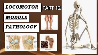 Loco pathology - cartilage forming tumors  #locomotor #pathology #osteochondroma #chondroma