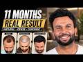 Hair Transplant in Gurgaon (HX-JHIM) | Best Results & Cost of Hair Transplant in Gurgaon