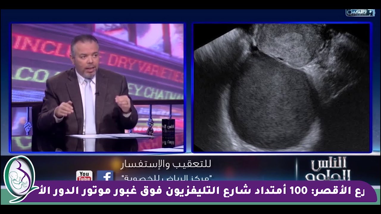 بالسونار نقدر نفرق بين انواع اكياس المبيض