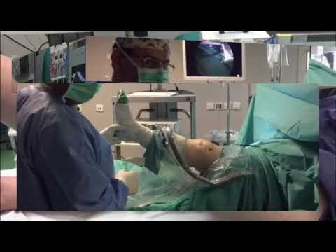 Βίντεο: 4 τρόποι αντιμετώπισης και αποκατάστασης από την πλήρη χειρουργική αντικατάσταση γόνατος