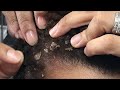 Dandruff flake scratching cap flakes pt 1 of 2