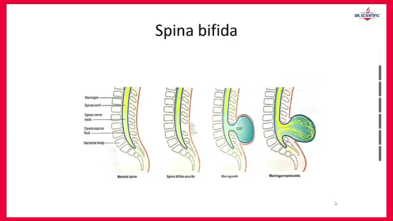 Nervous System Developmental Abnormalities | Pathology II Explained | CNS Disorders Made Easy---