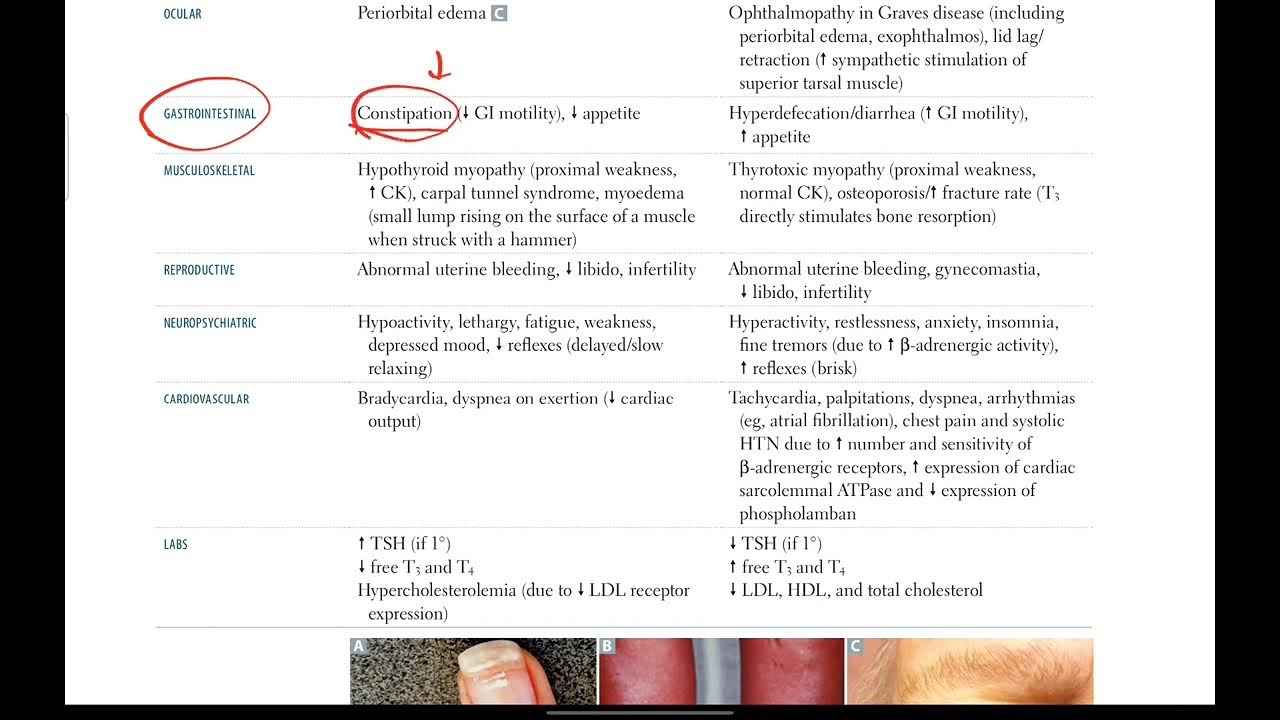 USMLE Step 1 Hyperthyroidism, Hypothyroidism Endocrinology 3