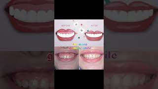 No more gummy smile