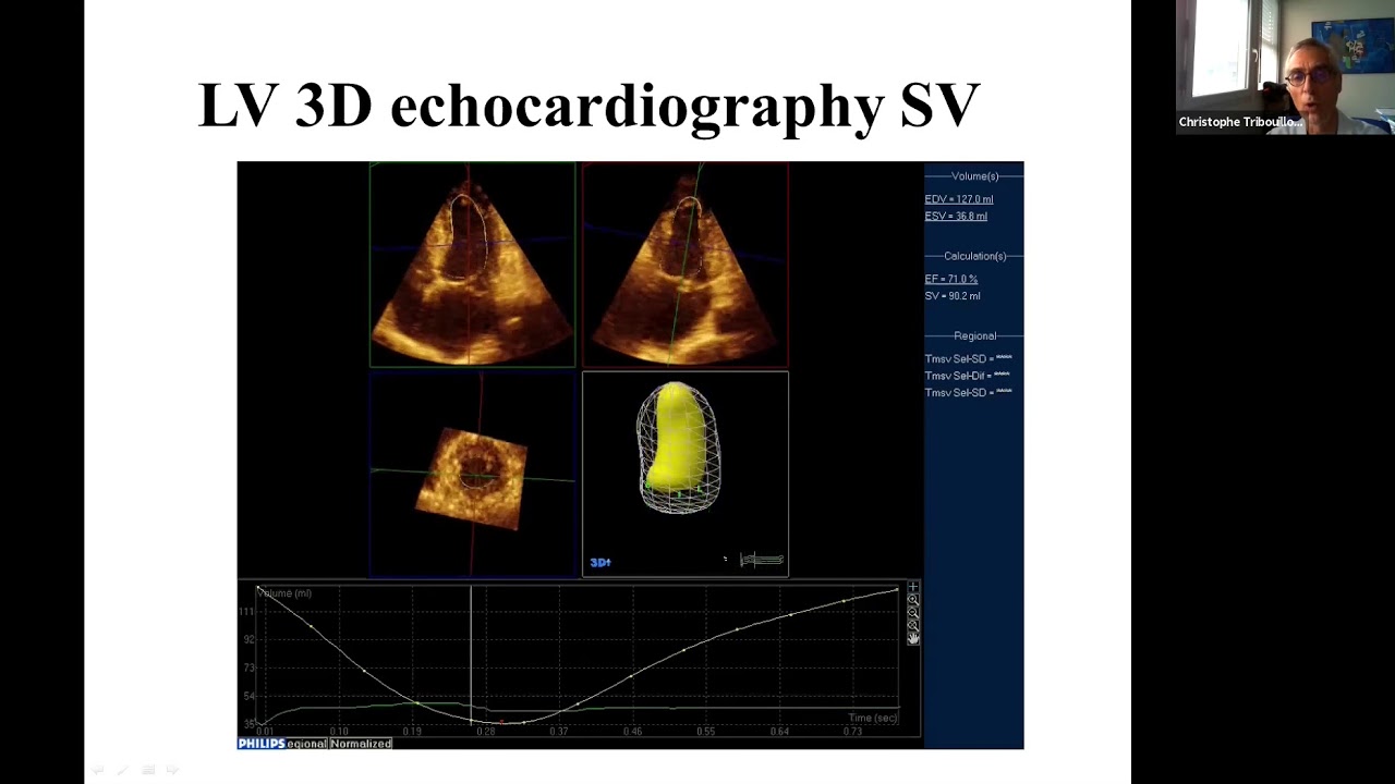 Quantification de l’IM au cours du PVM : pièges et limites | C. Tribouilloy (Amiens, France)