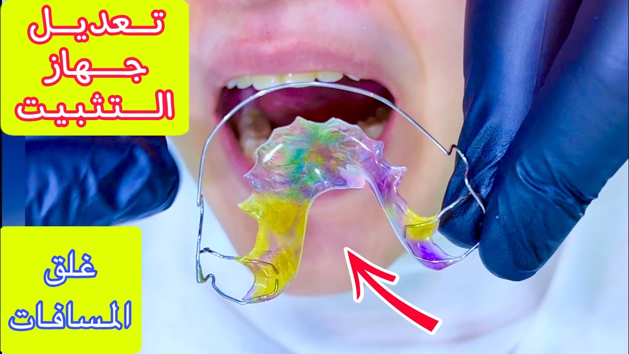 تجميل الأسنان الأماميه في الفك العلوي و غلق المسافات - تعديل جهاز التثبيت بعد تقويم الاسنان