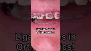 Types of ligation with Braces - Tooth Time Family Dentistry New Braunfels Texas screenshot 1