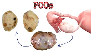 Polycystic ovary syndrome  (PCOs) - متلازمة المبيض متعدد الكيسات