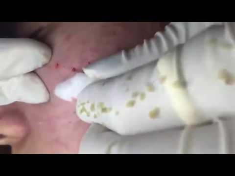 Wow Cystic Acne Treatment Under Skin Removal Pimple On Cheek And Chin Supper Pimple Popper