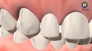 Các Trường Hợp Cần Niềng Răng