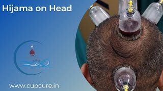 Doing Hijama on Head | CupCure Hijama Training