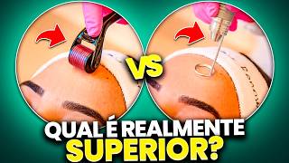 Microagulhamento ou Radiofrequência Microagulhada: Qual é melhor para sua pele?