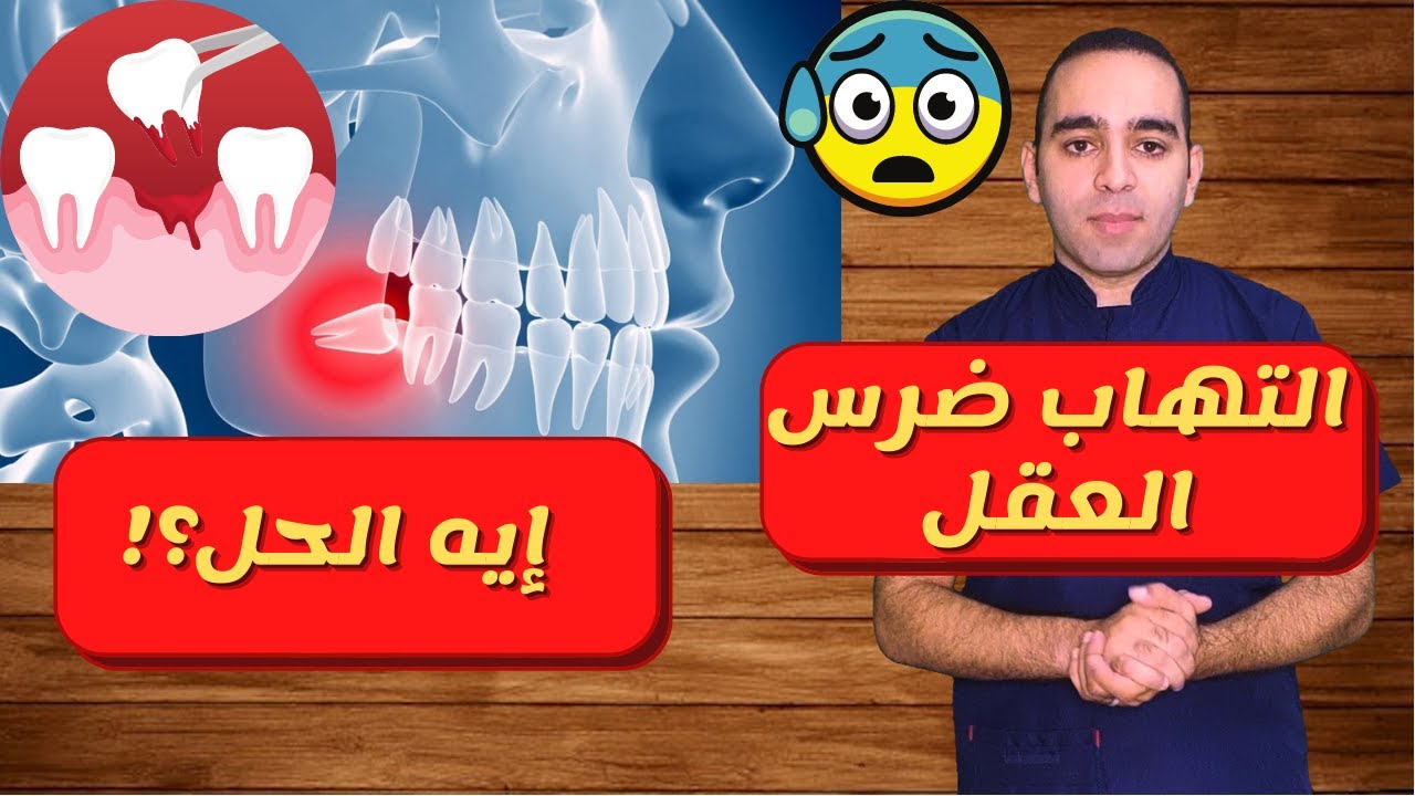 التهاب ضرس العقل 🔥 مشاكل وعلاج ضرس العقل 🦷 ضرس العقل نخلعة ولا لا؟ ليه اسمه ضرس العقل wisdom tooth