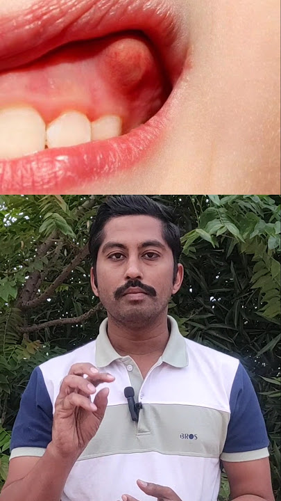 Download lagu 😫mouth ulcer cure immediately | mouthulcer home remedy | vai pun treatment in tamil