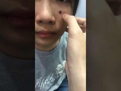 Video CÓ NÊN TẨY NỐT RUỒI HAY KHÔNG? - DRILL SAFETY AND... - youtube